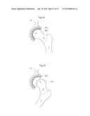 HIP JOINT DEVICE AND METHOD diagram and image