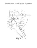 BONE PREPARATION TOOL KIT AND ASSOCIATED METHOD diagram and image