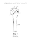 BONE PREPARATION TOOL KIT AND ASSOCIATED METHOD diagram and image