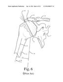 BONE PREPARATION TOOL KIT AND ASSOCIATED METHOD diagram and image