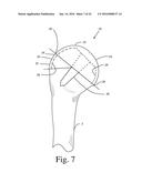 BONE PREPARATION TOOL KIT AND ASSOCIATED METHOD diagram and image