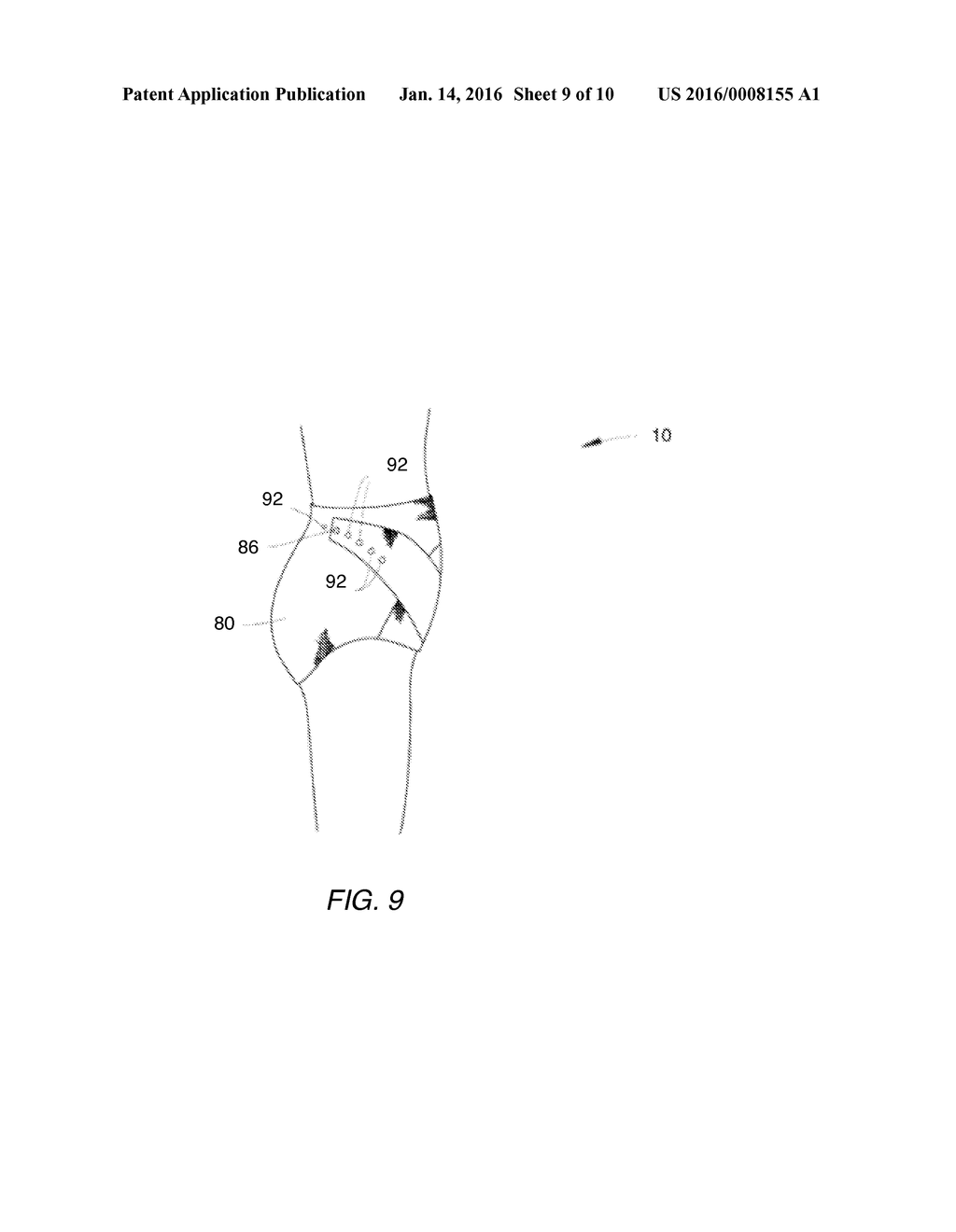 Noninvasive Method and Apparatus for Facilitating Weight Loss - diagram, schematic, and image 10