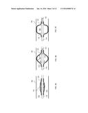 OCCLUSION DEVICE CAPABLE OF OCCLUDING AN EAR CANAL diagram and image