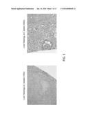 Autologous Tumor Lysate-loaded Dendritic Cell Vaccine for Treatment of     Liver Cancer diagram and image