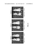 Autologous Tumor Lysate-loaded Dendritic Cell Vaccine for Treatment of     Liver Cancer diagram and image