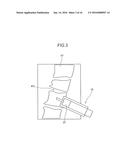 ADHESIVE BONE FILLING AGENT AND ADHESIVE BONE FILLING AGENT KIT diagram and image