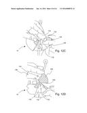 PERCUTANEOUS PORT GUARD DRESSING diagram and image