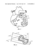 Guidewires and Methods for Percutaneous Occlusion Crossing diagram and image