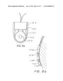 IMPLANT MAGNET SYSTEM diagram and image