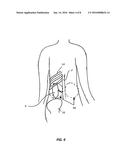 IMAGE-GUIDED FOCUSED ULTRASOUND ABLATION diagram and image