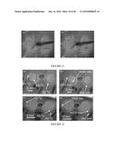 CATHETER-BASED ULTRASOUND TRANSDUCERS diagram and image