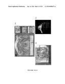 CATHETER-BASED ULTRASOUND TRANSDUCERS diagram and image