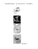 CATHETER-BASED ULTRASOUND TRANSDUCERS diagram and image