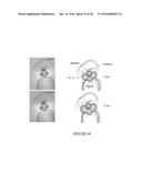 CATHETER-BASED ULTRASOUND TRANSDUCERS diagram and image