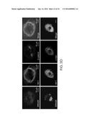 SPECIFIC DETECTION TOOL FOR MESENCHYMAL AND EPITHELIAL-MESENCHYMAL     TRANSFORMED CIRCULATING TUMOR CELLS diagram and image