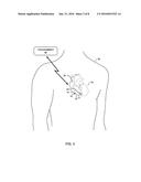 LEADLESS PACING SYSTEM INCLUDING SENSING EXTENSION diagram and image