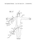 FILAMENTARY DEVICES FOR TREATMENT OF VASCULAR DEFECTS diagram and image