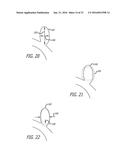 FILAMENTARY DEVICES FOR TREATMENT OF VASCULAR DEFECTS diagram and image