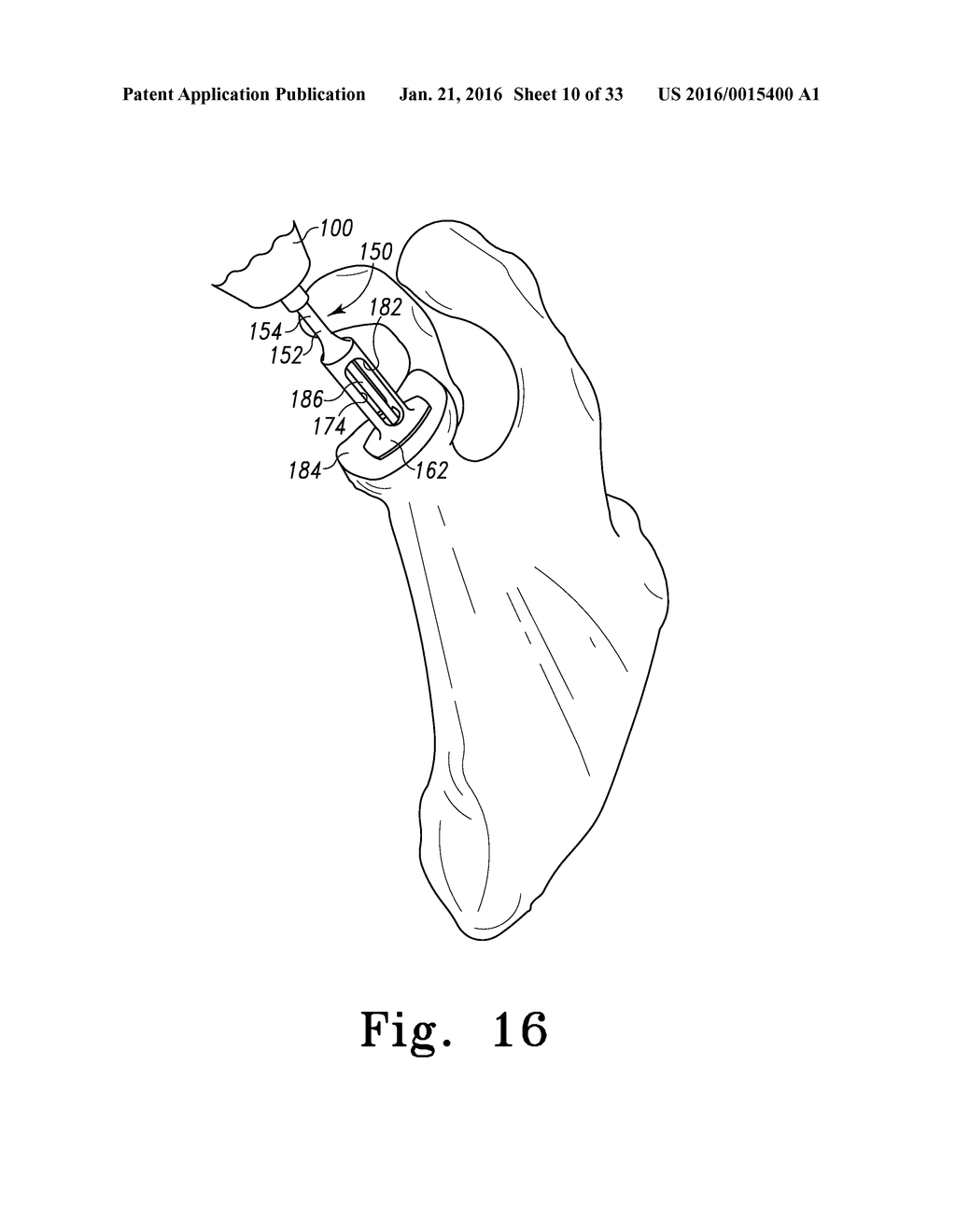 RECIPROCATING RASPS FOR USE IN AN ORTHOPAEDIC SURGICAL PROCEDURE - diagram, schematic, and image 11