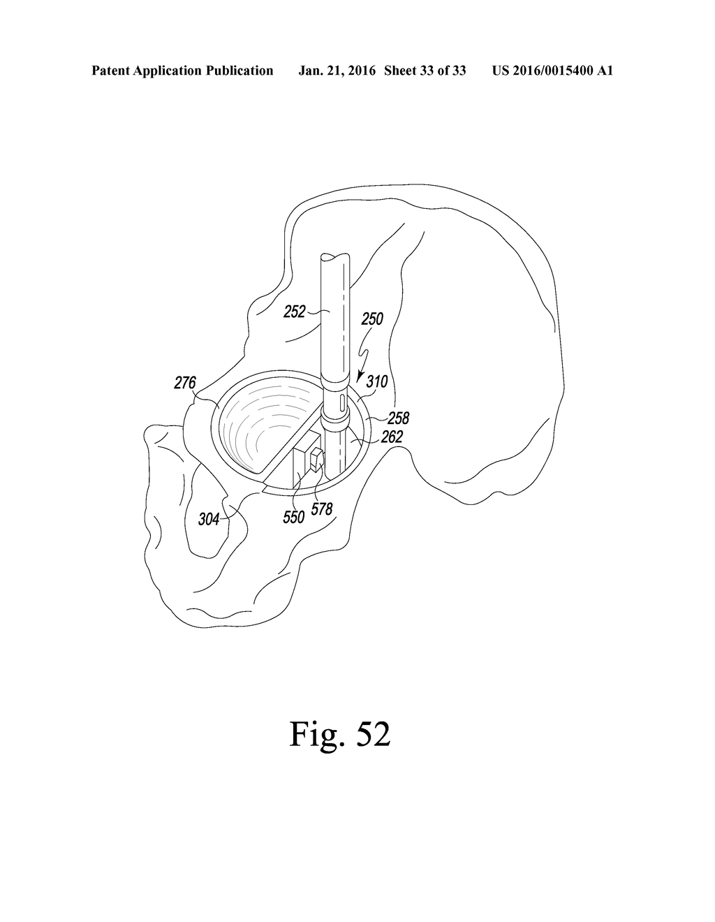 RECIPROCATING RASPS FOR USE IN AN ORTHOPAEDIC SURGICAL PROCEDURE - diagram, schematic, and image 34