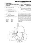 DEVICES AND METHODS FOR INTRAHEPATIC SHUNTS diagram and image