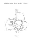 DEVICES AND METHODS FOR INTRAHEPATIC SHUNTS diagram and image