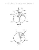 DEVICES AND METHODS FOR INTRAHEPATIC SHUNTS diagram and image