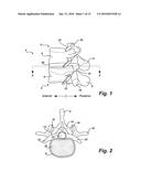 INVERTED SERPENTINE SPINAL STABILITY DEVICE AND ASSOCIATED METHODS diagram and image