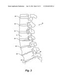 INVERTED SERPENTINE SPINAL STABILITY DEVICE AND ASSOCIATED METHODS diagram and image