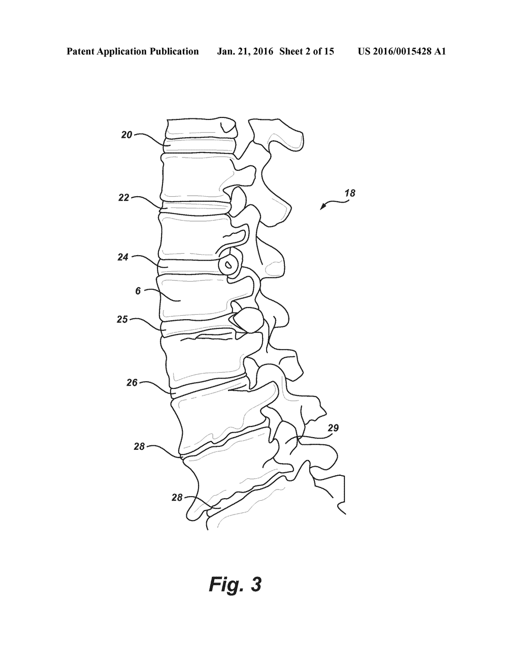 INVERTED SERPENTINE SPINAL STABILITY DEVICE AND ASSOCIATED METHODS - diagram, schematic, and image 03