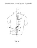 INVERTED SERPENTINE SPINAL STABILITY DEVICE AND ASSOCIATED METHODS diagram and image