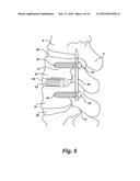 INVERTED SERPENTINE SPINAL STABILITY DEVICE AND ASSOCIATED METHODS diagram and image