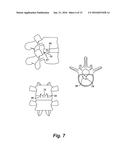 INVERTED SERPENTINE SPINAL STABILITY DEVICE AND ASSOCIATED METHODS diagram and image