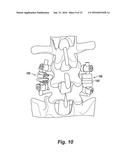 INVERTED SERPENTINE SPINAL STABILITY DEVICE AND ASSOCIATED METHODS diagram and image