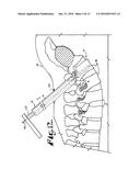 METHOD FOR IMPLANTING A ROD IMPLANT ALONG A SPINE OF A PATIENT diagram and image