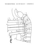 METHOD FOR IMPLANTING A ROD IMPLANT ALONG A SPINE OF A PATIENT diagram and image