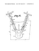 METHOD FOR IMPLANTING A ROD IMPLANT ALONG A SPINE OF A PATIENT diagram and image