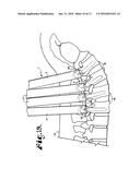 METHOD FOR IMPLANTING A ROD IMPLANT ALONG A SPINE OF A PATIENT diagram and image