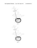 Steerable Cannula for Delivering Bone Filler diagram and image