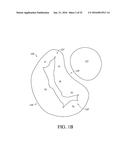 ADJUSTABLE ENDOLUMENAL IMPLANT FOR RESHAPING THE MITRAL VALVE ANNULUS diagram and image