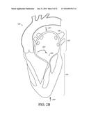 ADJUSTABLE ENDOLUMENAL IMPLANT FOR RESHAPING THE MITRAL VALVE ANNULUS diagram and image