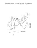 ADJUSTABLE ENDOLUMENAL IMPLANT FOR RESHAPING THE MITRAL VALVE ANNULUS diagram and image