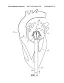 ADJUSTABLE ENDOLUMENAL IMPLANT FOR RESHAPING THE MITRAL VALVE ANNULUS diagram and image