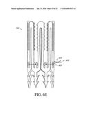 ADJUSTABLE ENDOLUMENAL IMPLANT FOR RESHAPING THE MITRAL VALVE ANNULUS diagram and image