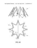 ADJUSTABLE ENDOLUMENAL IMPLANT FOR RESHAPING THE MITRAL VALVE ANNULUS diagram and image