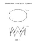 ADJUSTABLE ENDOLUMENAL IMPLANT FOR RESHAPING THE MITRAL VALVE ANNULUS diagram and image