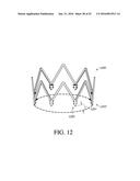 ADJUSTABLE ENDOLUMENAL IMPLANT FOR RESHAPING THE MITRAL VALVE ANNULUS diagram and image