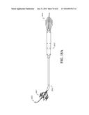 ADJUSTABLE ENDOLUMENAL IMPLANT FOR RESHAPING THE MITRAL VALVE ANNULUS diagram and image