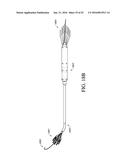 ADJUSTABLE ENDOLUMENAL IMPLANT FOR RESHAPING THE MITRAL VALVE ANNULUS diagram and image