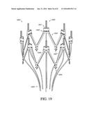 ADJUSTABLE ENDOLUMENAL IMPLANT FOR RESHAPING THE MITRAL VALVE ANNULUS diagram and image